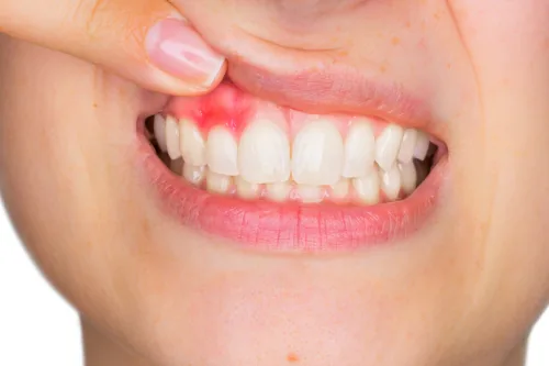 طب اللثة (علاج اللثة) | Dent Elitium